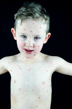 Caucasian boy with chickenpox infection, rash and blisters. Portrait studio shot with black background.