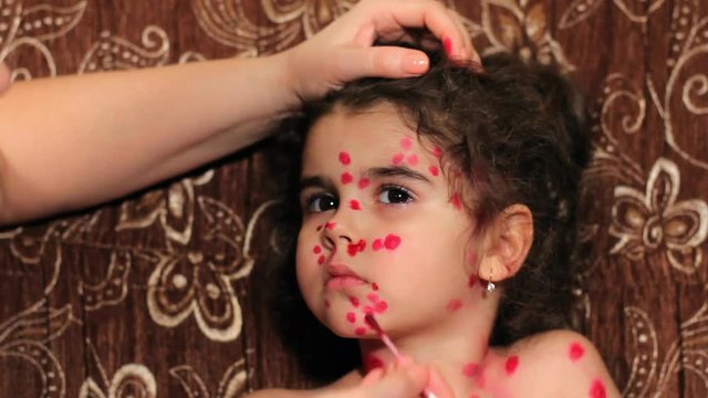 Beautiful little girl has chicken pox. Child's face close up. Female arms smear an eruption on a face with medicine