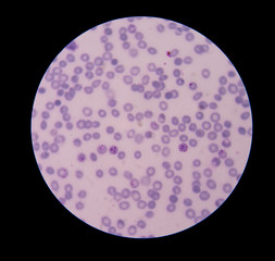 Malaria ring form infection on red blood cells.