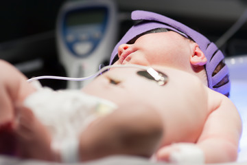 sleeping newborn baby receiving uv phototherepy for jaundice in hospital