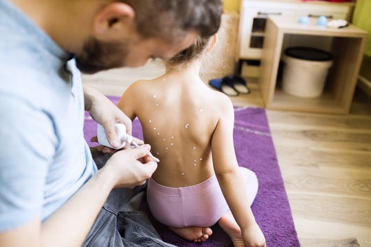 Father at home caring for daughter having chickenpox