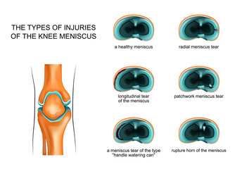 types of meniscus tear - obrazy, fototapety, plakaty