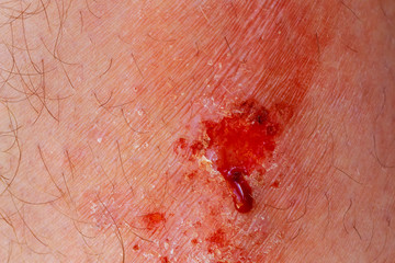 Closeup of wound and dry blood on leg.