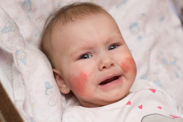 Cute baby with eczema on her face crying in pain