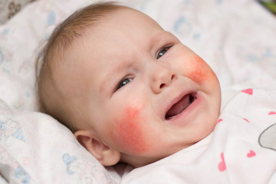 Cute Baby With Eczema On Her Face Crying In Pain