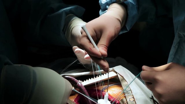 Doctors surgeons perform open heart surgery. Close-up