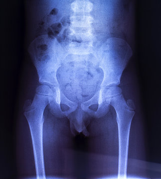 X-ray of the pelvic bones of the child.