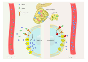 diabetes and mechanism of insulin resistance - obrazy, fototapety, plakaty
