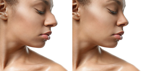 Young African-American woman before and after rhinoplasty on white background. Plastic surgery...