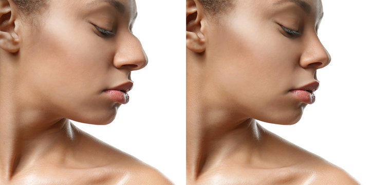 Young African-American woman before and after rhinoplasty on white background. Plastic surgery concept