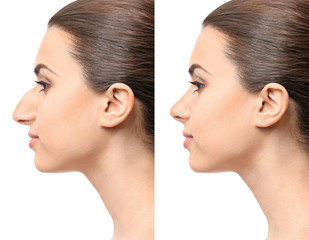 Young woman before and after rhinoplasty on white background. Plastic surgery concept