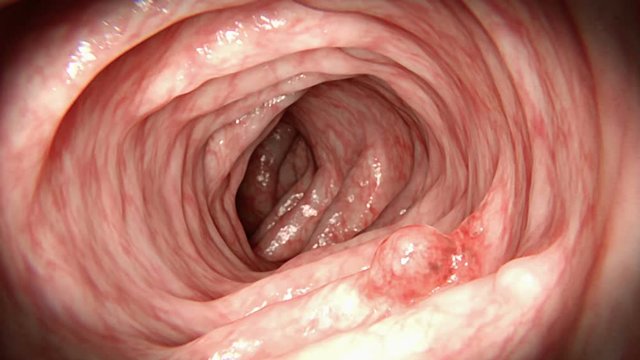 Polyp tumour in instestines, animation