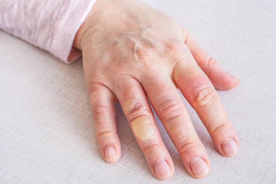 hand with second degree burns