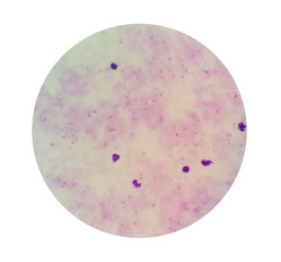 Microscopic examination of thick blood films smear from malaria infected patients present morphology of malaria parasite in human red blood cells.