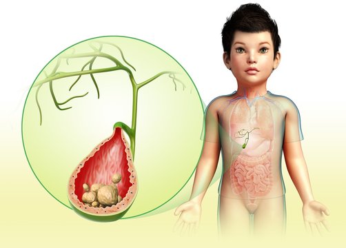 Child with gallstones, illustration