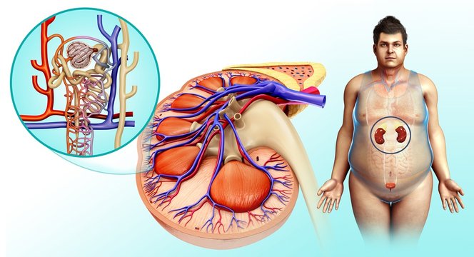 Obese man's kidney, illustration