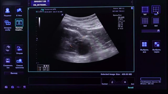 Image on the monitor of a medical ultrasound machine.