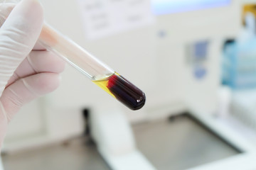 Clotted blood  with serum in tes tube  laboratory background.