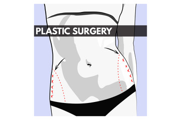 Body Plastic Surgery. Vector Illustration.