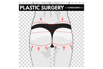 Plastic surgery. Body correction. Isolated vector Illustration.