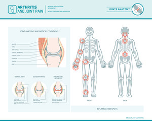 Arthritis and joint pain infographic