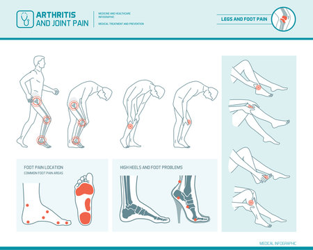 Foot pain and arthritis infographic