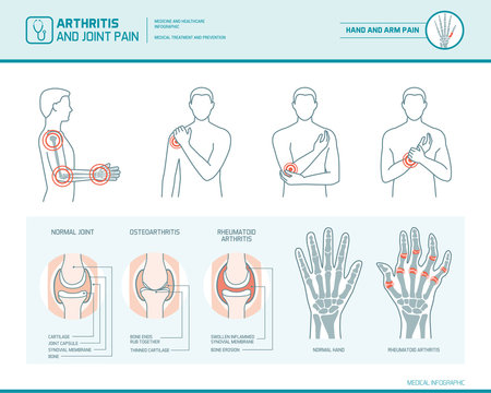 Arthritis and joint pain