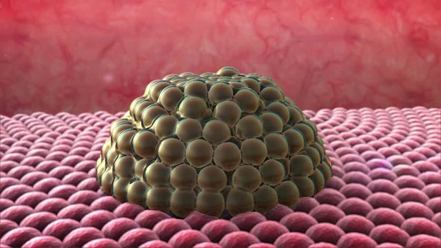 3d rendered cancer cell, Clusters of cells, Cancer cell and Lymphocytes, T-lymphocytes attack a migrating cancer cell, Cancer cell attacked by lymphocytes, Macrophage attack of the cells