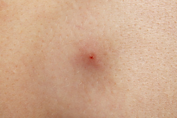 Human skin with pimple, closeup