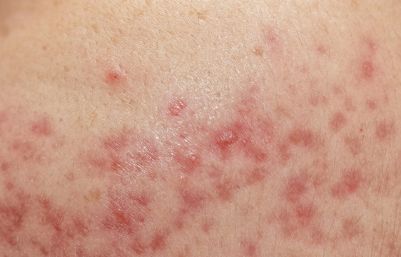 closeup skin problems, nodular cystic acne skin