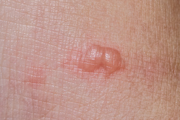 Closeup of skin with blisters.Burn wound skin