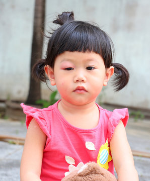 Asian baby girl eye swell, Allergy after mosquitoes biting at eye small girl
