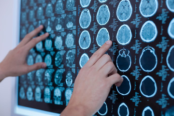 X ray images of human brain being put on the whiteboard