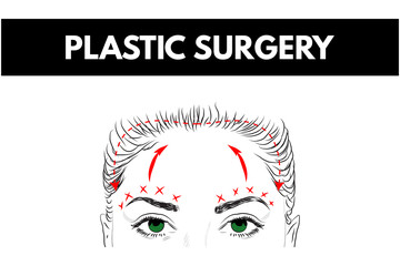 Brow lift. Plastic surgery. Cosmetic surgery. Vector Illustration. 