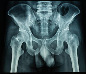 X Ray file of human palvis in black background