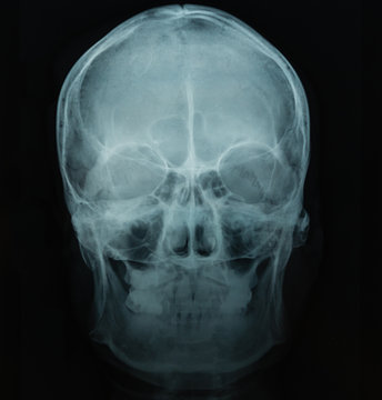 X Ray file of human skull in black background