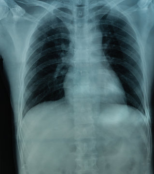 X Ray file of human Chest in black background