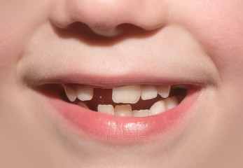 Naklejka premium Child mouth of toddler without anterior milky tooth. Toothless smile. Child lost front tooth. Tooth Fairy. Children's dediatric dentistry, dental care, go to the dentist. Frank carefree serene smile