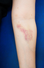 bruised Blood in woman arm