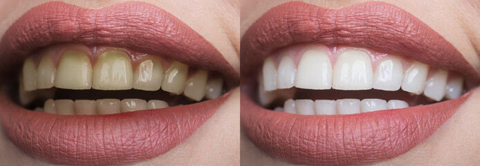 Teeth whitening at the dentist. Stomatology and dental clinic concept. Teeth before and after....