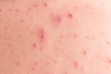 Chicken pox rash
