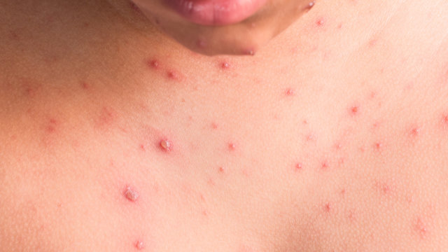 Chicken pox rash