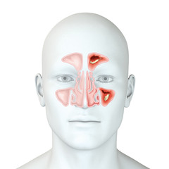 Paranasal sinusitis, medical illustration