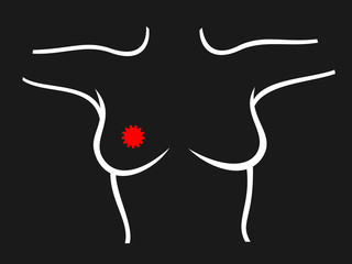 Breast cancer diagnosis - scanning of chest of woman. Detection of lump - tumor, carcinoma. Simple vector illustration