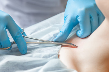Operation to install microdermal piercing