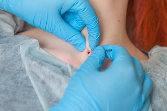 Operation to install microdermal piercing