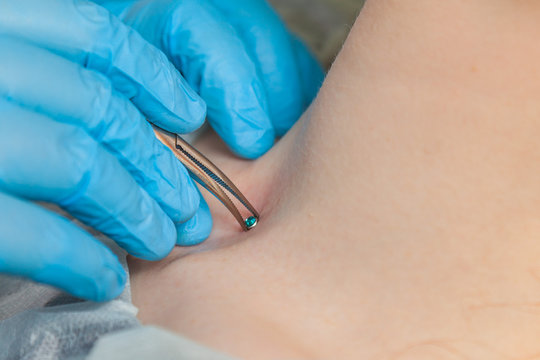 Operation to install microdermal piercing