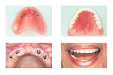 dental implant of upper jaw