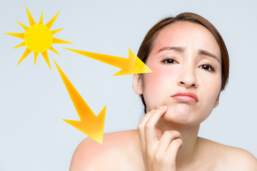 young woman with a bad sunburn on her face