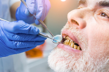 Dentist examining patient, close up. Elderly male with bad teeth. Tobacco use influences dental...